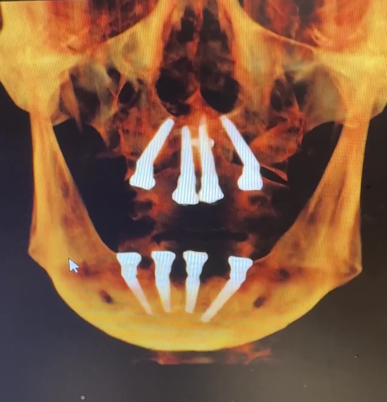 Case 19 — Dual-arch fixture distribution, coronal CBCT render