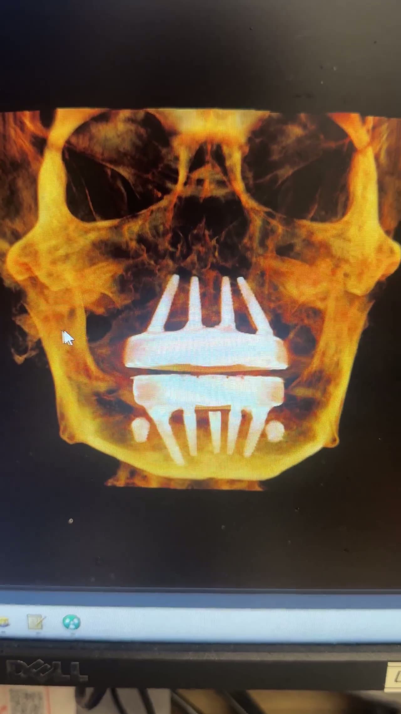 Case 17 — Dual-arch reconstruction, frontal skull render