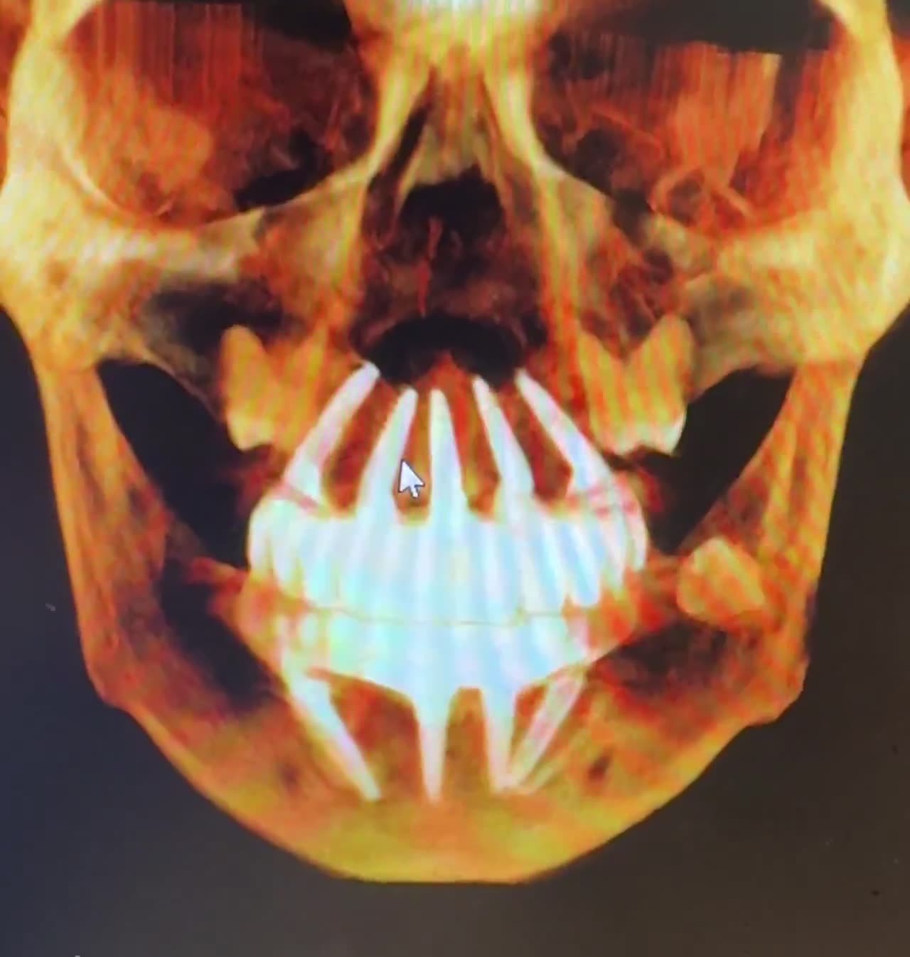Case 09 — Mandibular full-arch CBCT render
