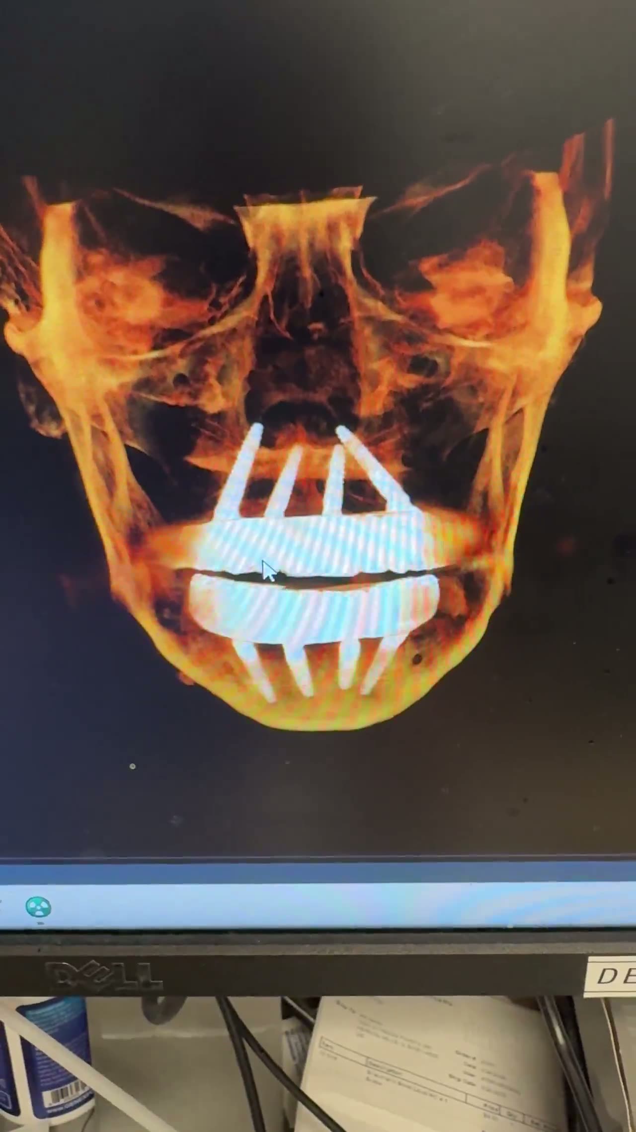 Case 05 — Dual-arch reconstruction, frontal volumetric render