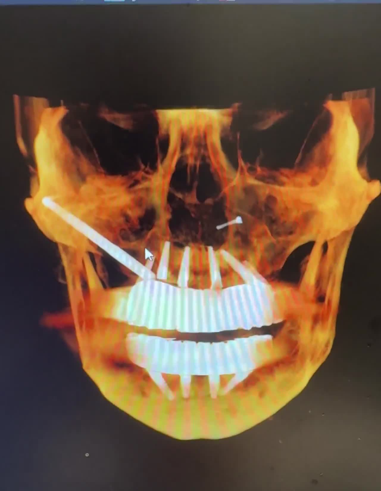 Case 14 — Zygomatic and pterygoid support, dual-arch render