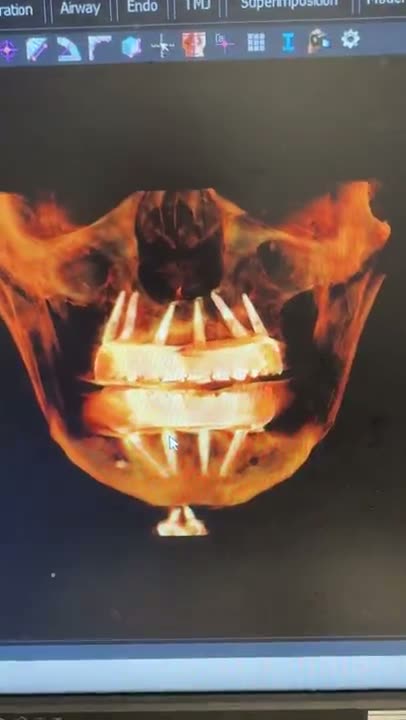 Case 03 — Mandibular full-arch implant positions