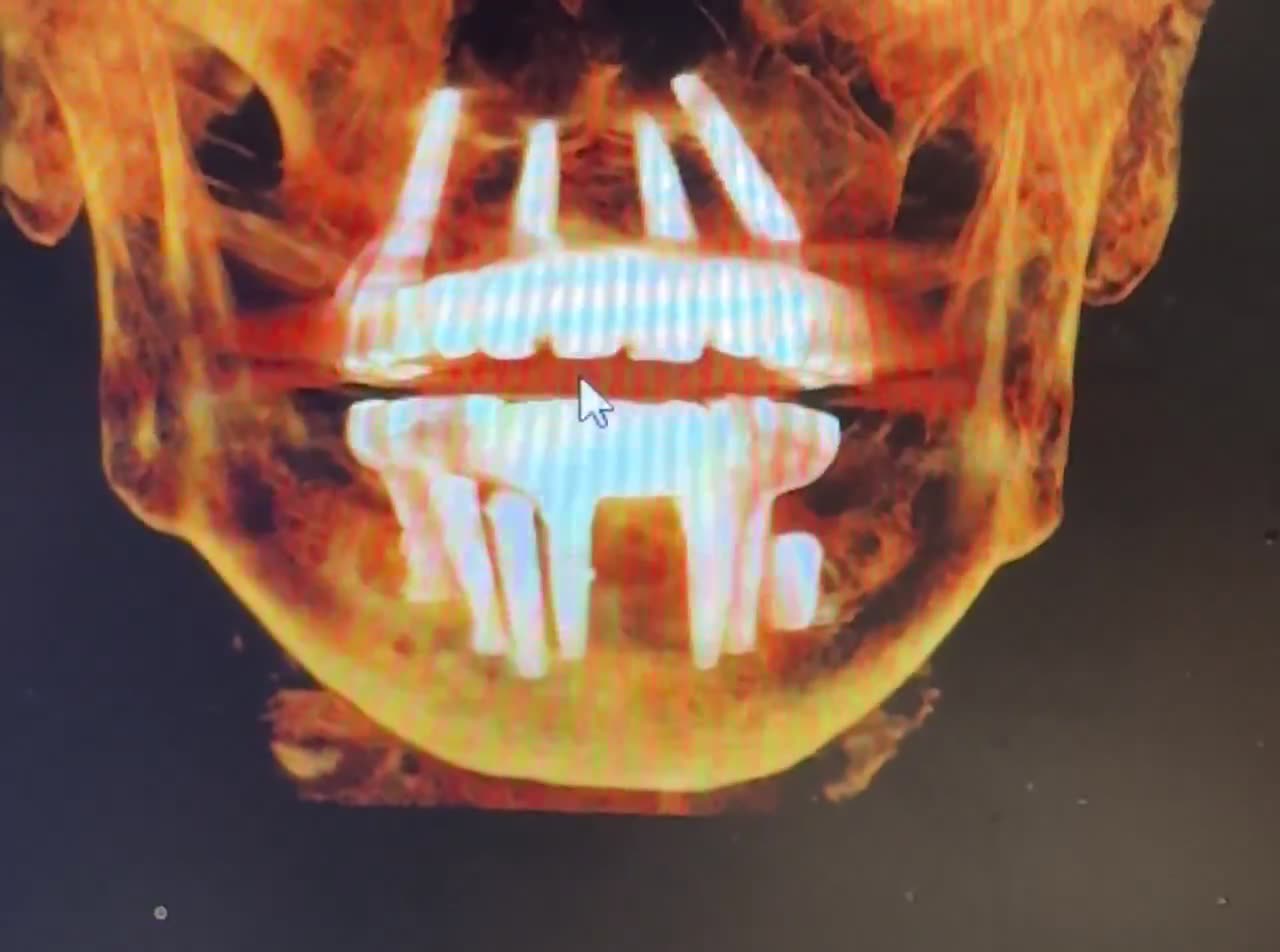 Case 15 — Dual-arch implants, inferior volumetric view