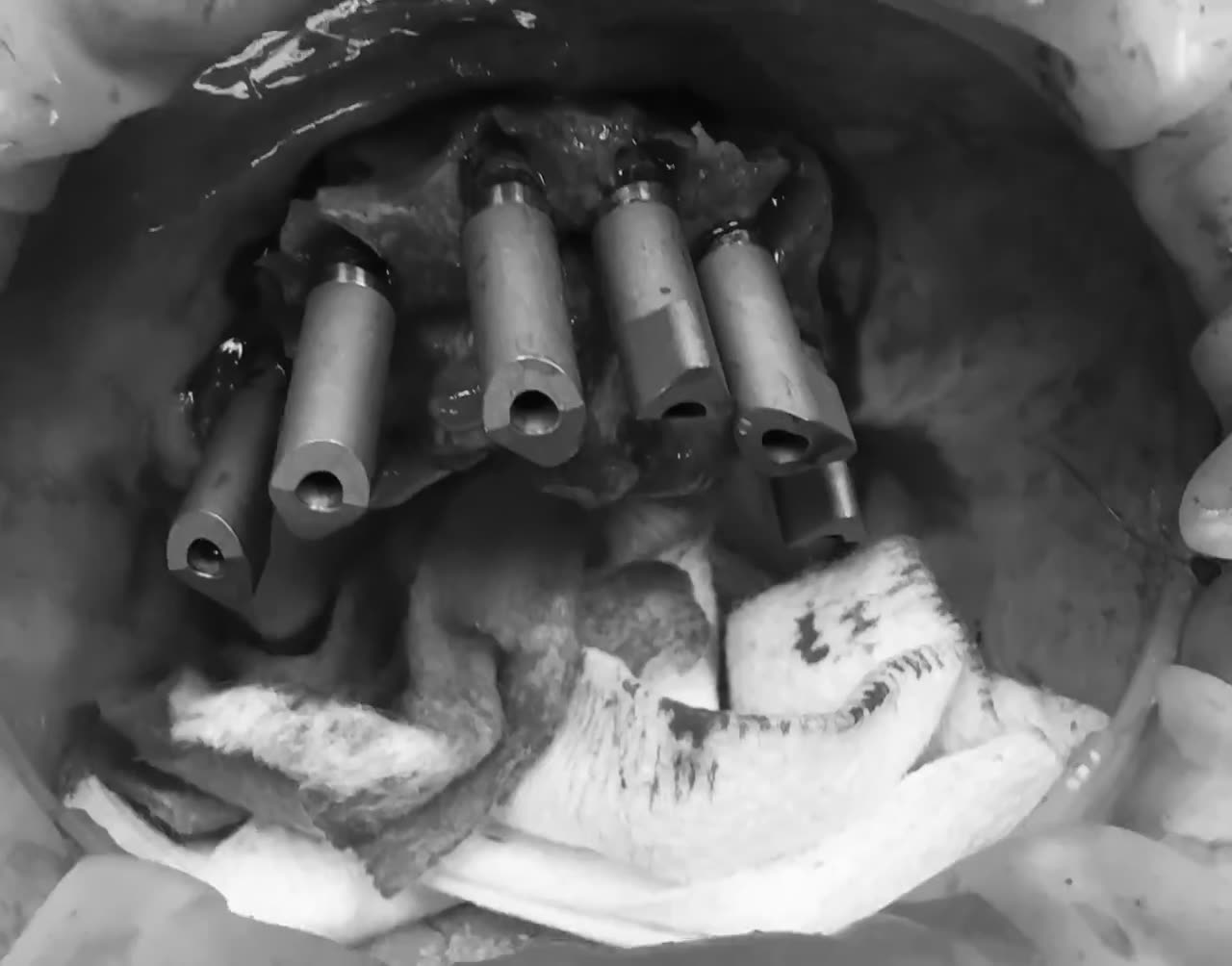 Case 11 — Multi-unit abutments seated, maxilla
