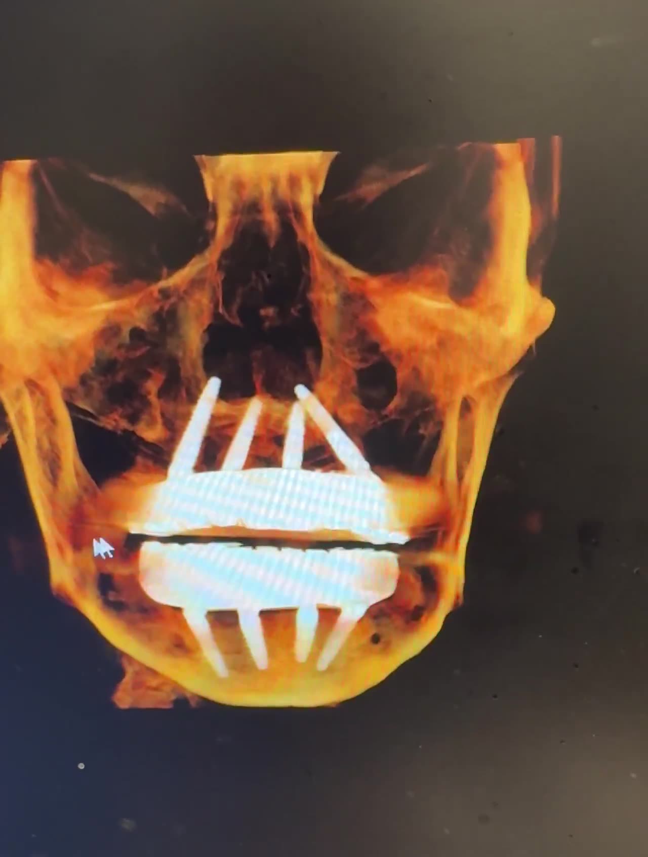 Case 13 — Tilted implant strategy, dual-arch render