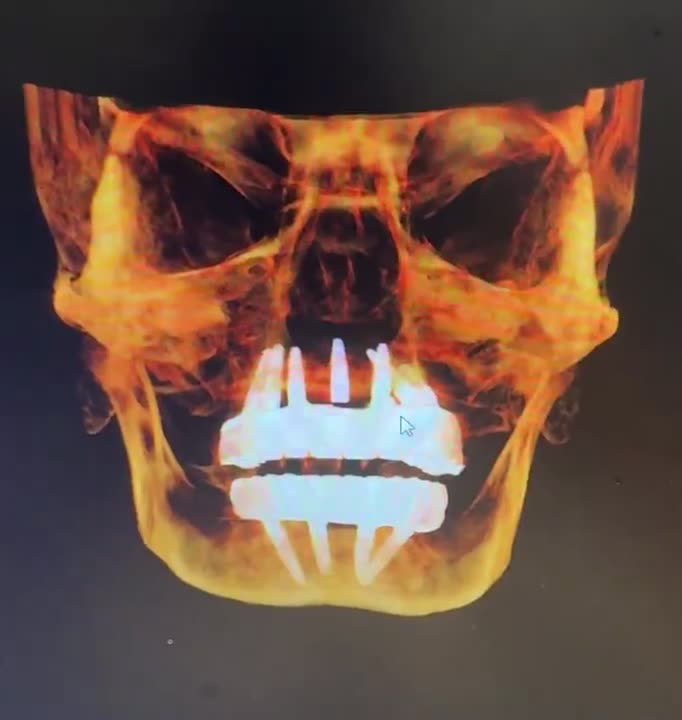 Case 02 — Dual-arch implant reconstruction