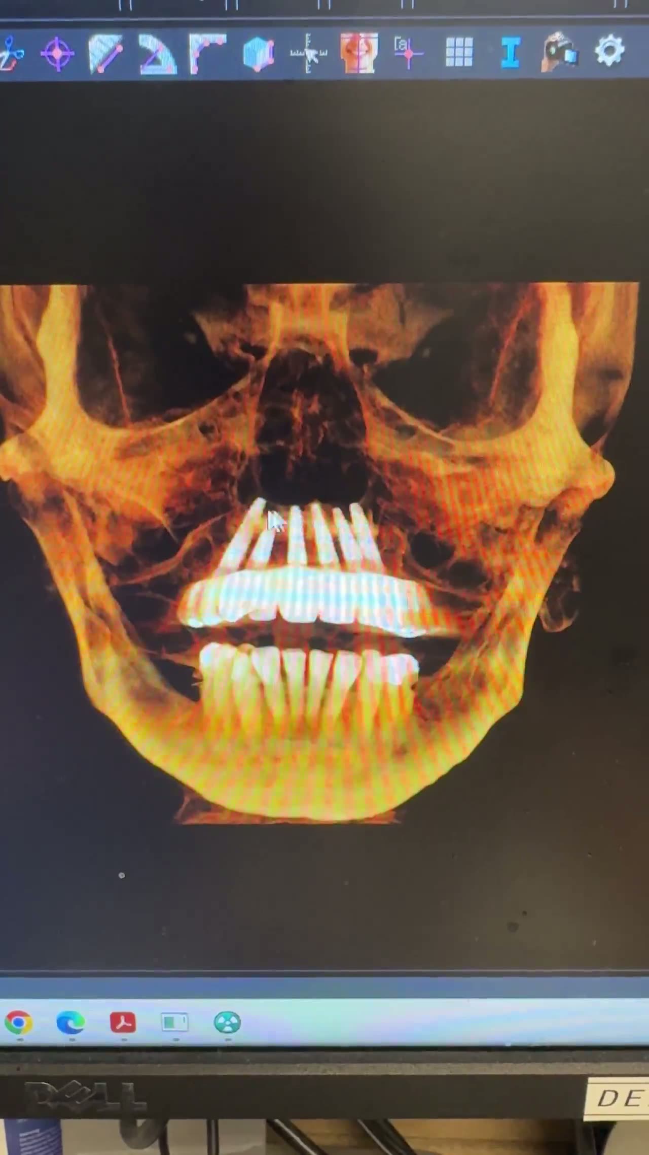 Case 12 — Dual-arch reconstruction, frontal CBCT render