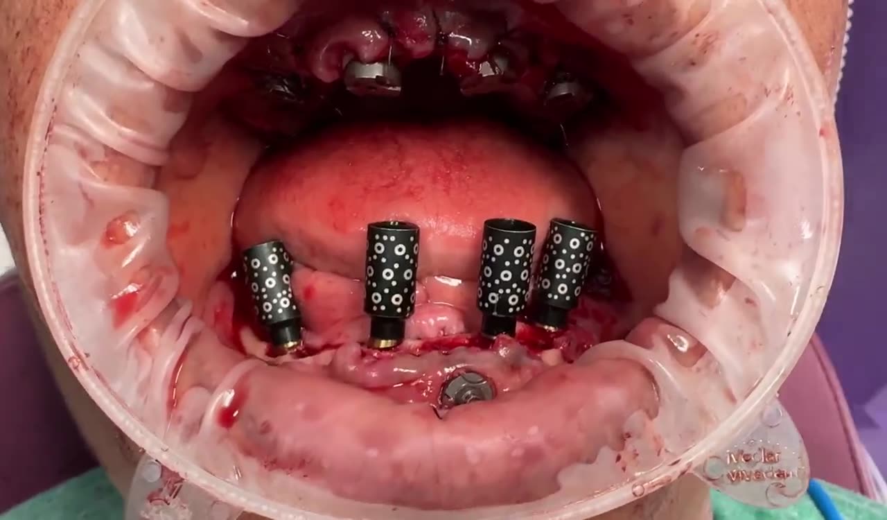 Case 07 — Multi-unit abutment placement, mandible