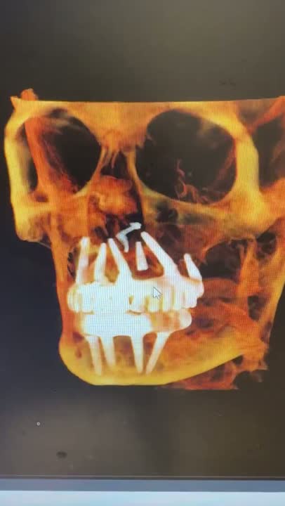 Case 01 — Maxillary full-arch CBCT review