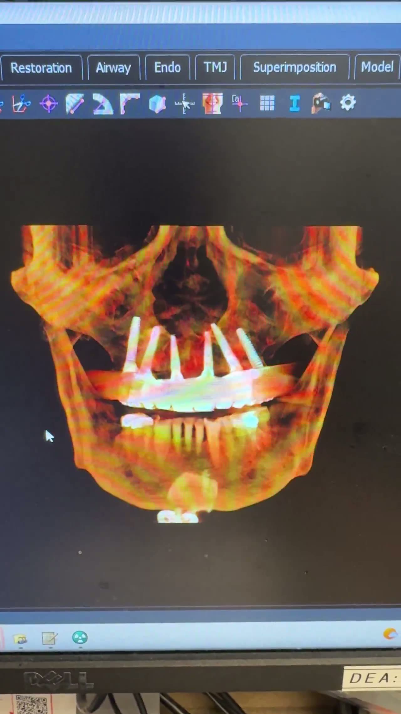 Case 16 — Maxillary full-arch with tilted posterior fixtures
