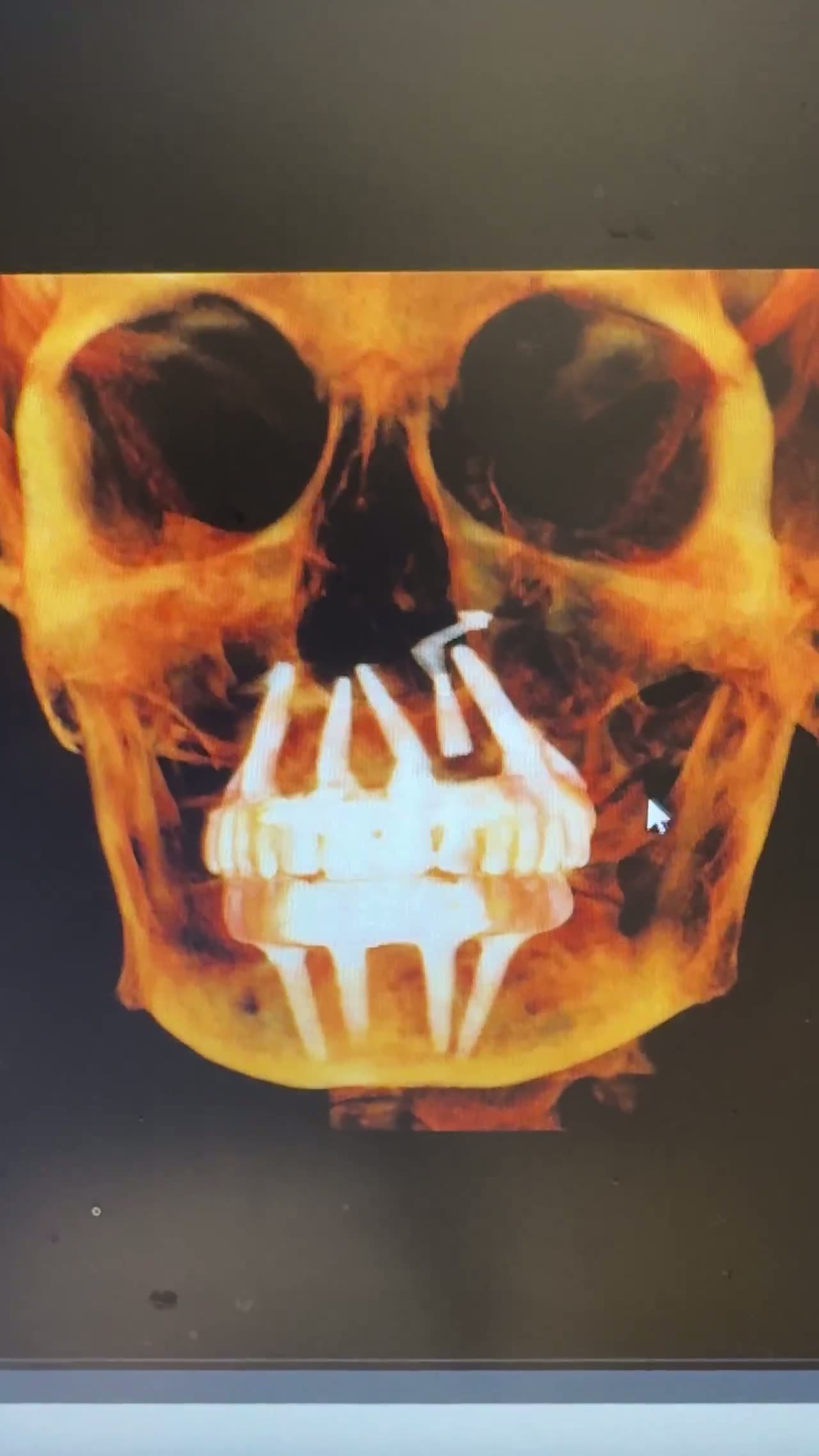 Case 18 — Extended-length maxillary support, dual-arch render