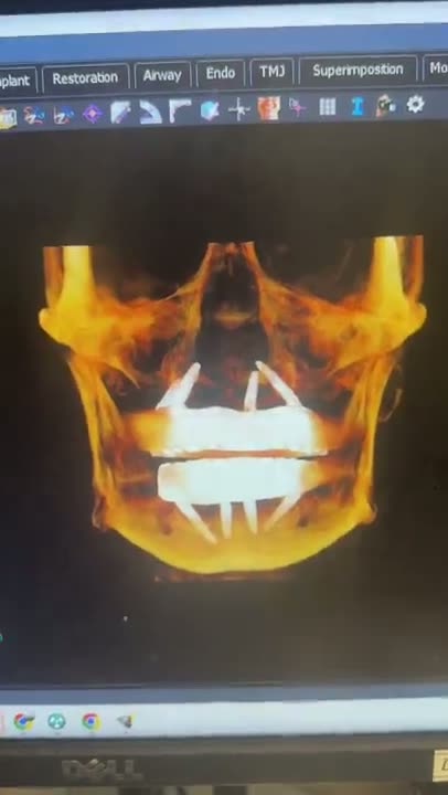 Case 04 — Full-arch planning review on CBCT software