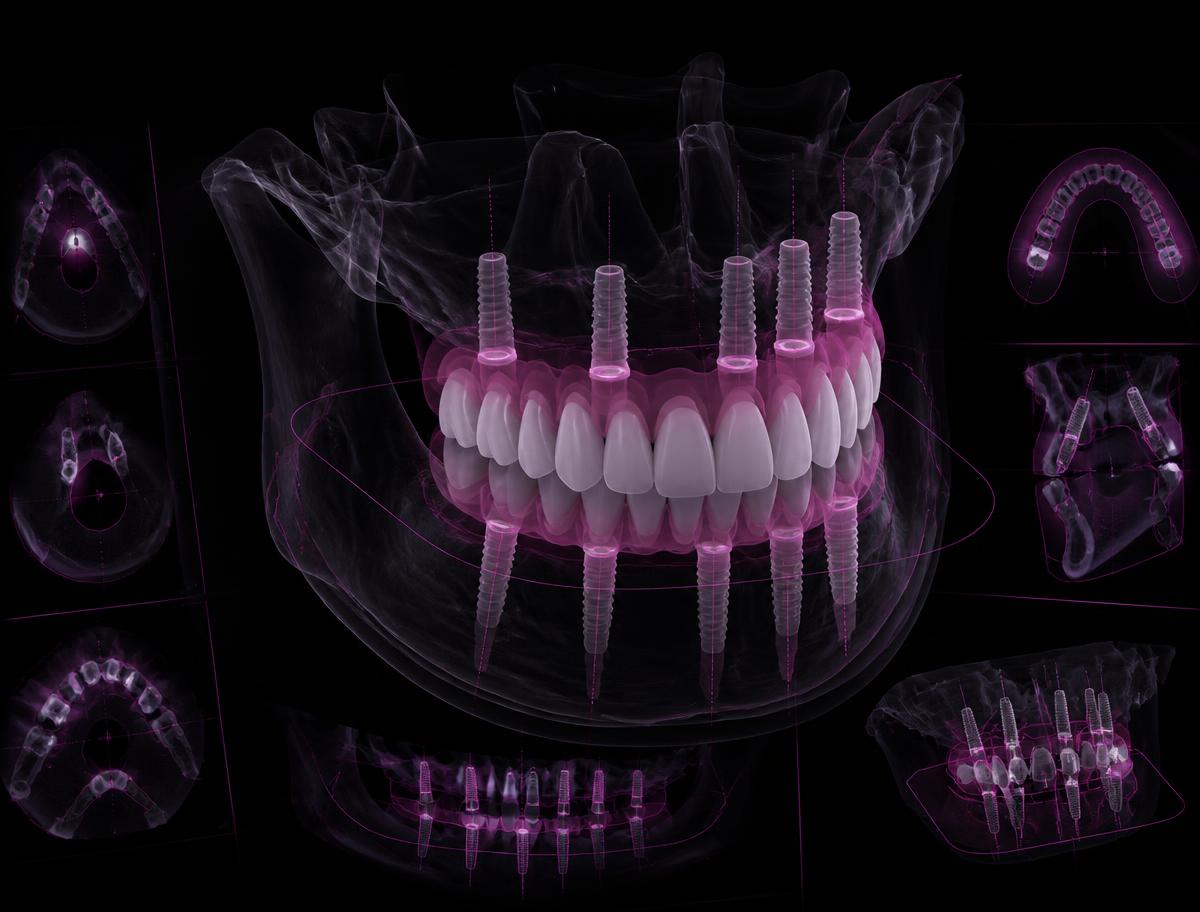 Digital full-arch implant treatment plan rendered over CBCT slices